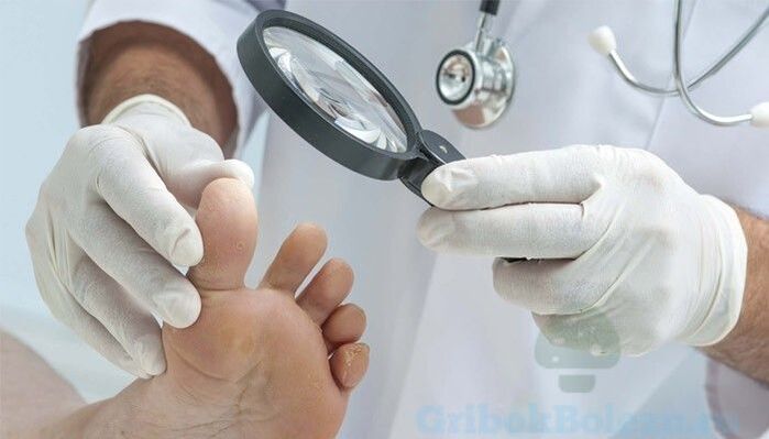 diagnostyka grzybicy stóp przez lekarza