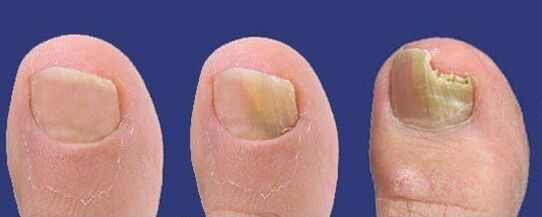 Rozwój grzybicy paznokci