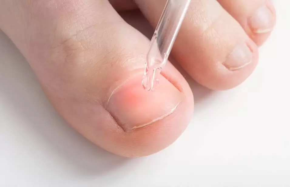 Leczenie grzybicy paznokci roztworem przeciwgrzybiczym