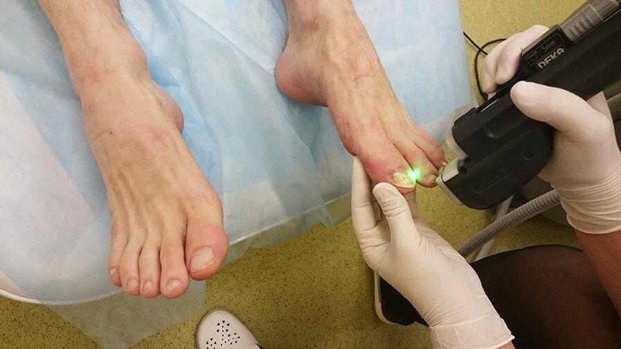 Laserowe leczenie grzybicy paznokci