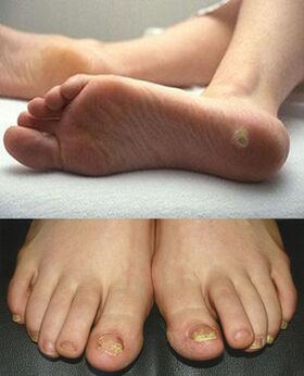 Objawy grzybicy na skórze i paznokciach stóp