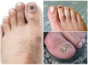 Objawy grzybicy paznokci u nóg