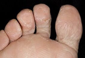 Skóra stóp z infekcją grzybiczą