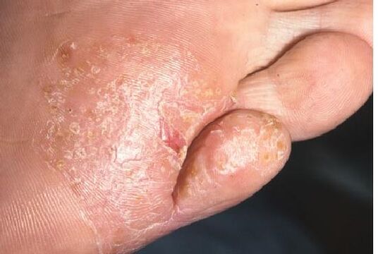 Objawy infekcji grzybiczej na skórze stóp