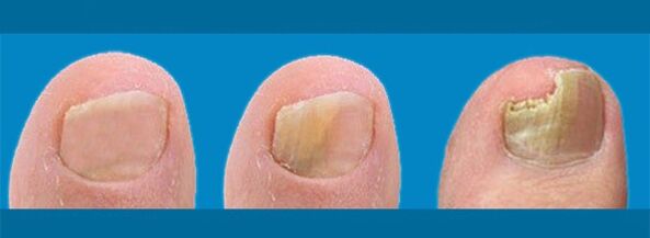 Rozwój grzybicy paznokci - grzyb paznokci